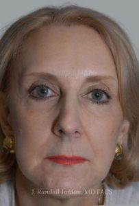 after facelift front view female patient case 1690