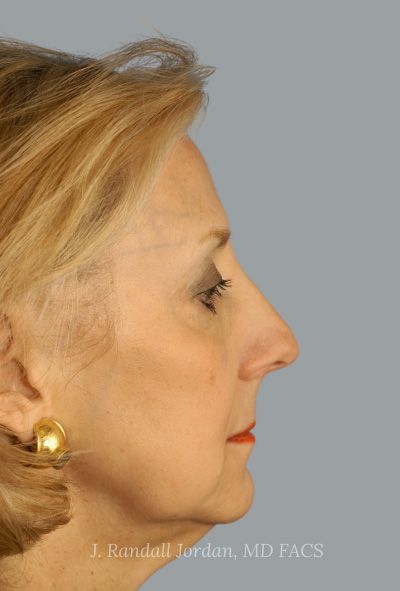 after facelift side view female patient case 1690