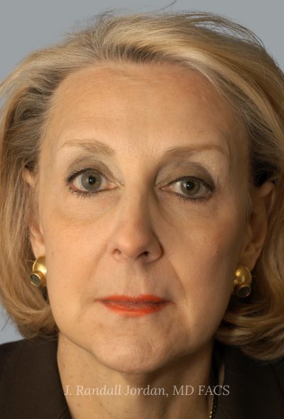 before facelift front view female patient case 1690