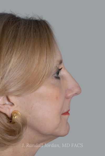 before facelift side view female patient case 1690