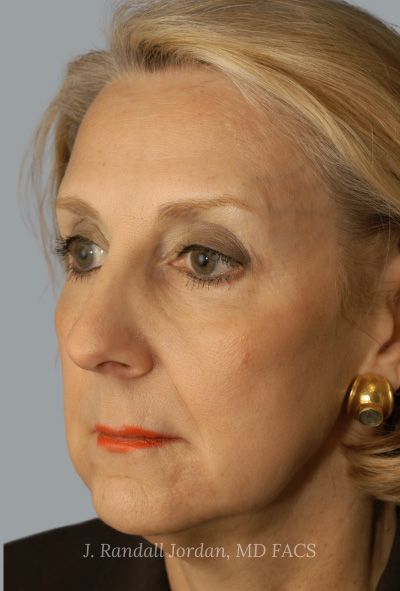 before facelift angle view female patient case 1690