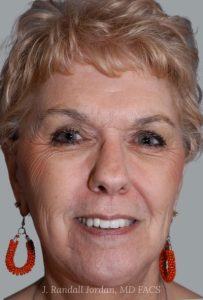 after facelift front view female patient case 1639